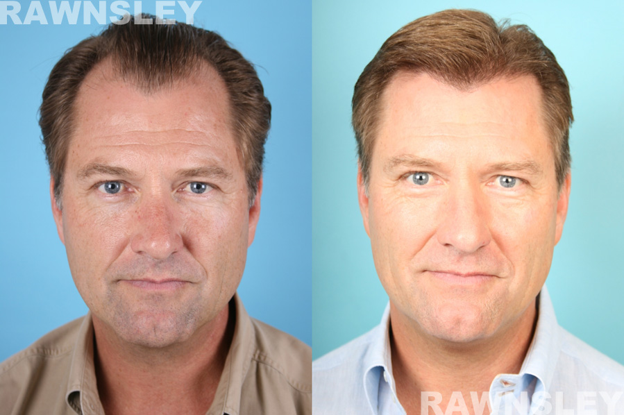 Hair Restoration Before and After Treatment Photos | Case 9 | Rawnsley Hair Restoration in Los Angeles, CA